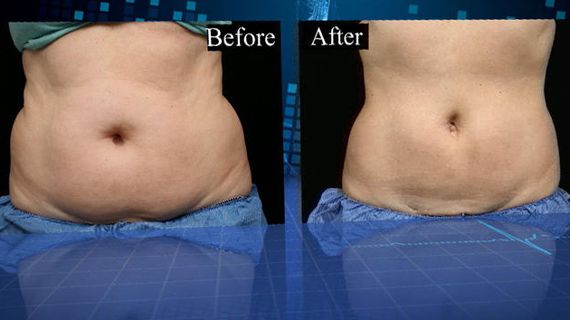 Fat Reduction Surgery